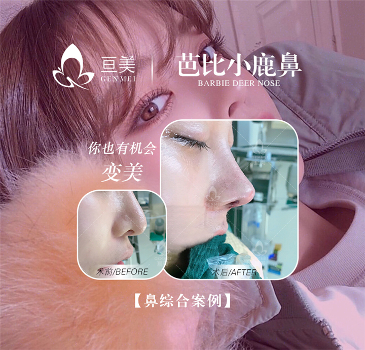 南昌鼻综合整形