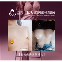 南昌隆胸整形多少钱