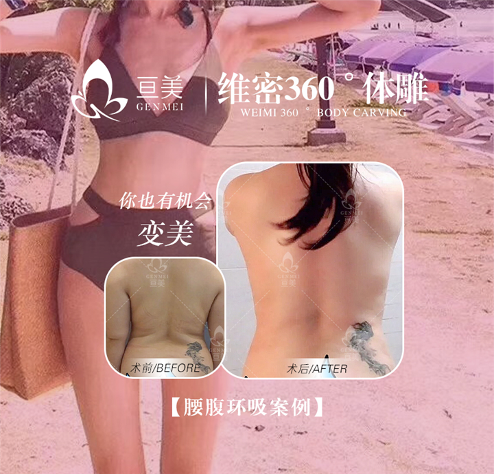 南昌抽脂整形
