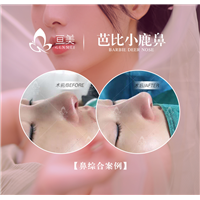 南昌亘美医疗鼻整形案例