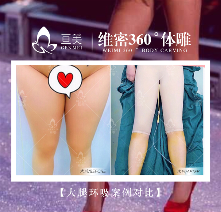 南昌大腿环吸案例
