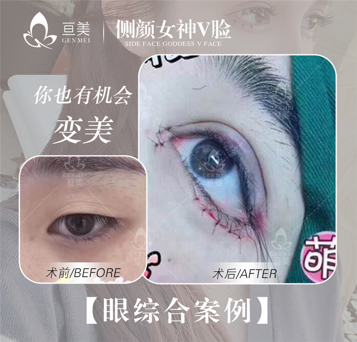 亘美医疗眼综合案例