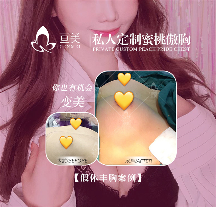 南昌假体丰胸