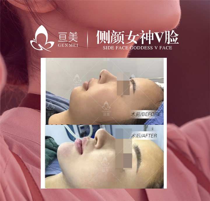 南昌下巴整形多少钱