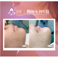 南昌下巴整形哪家好
