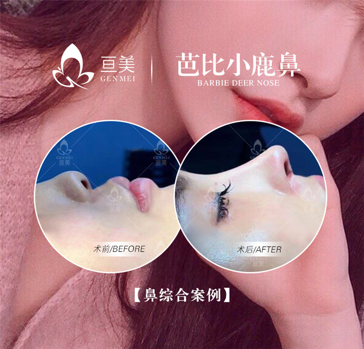 亘美医疗鼻整形怎么样