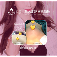 南昌假体丰胸