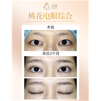 南昌眼整形多少钱
