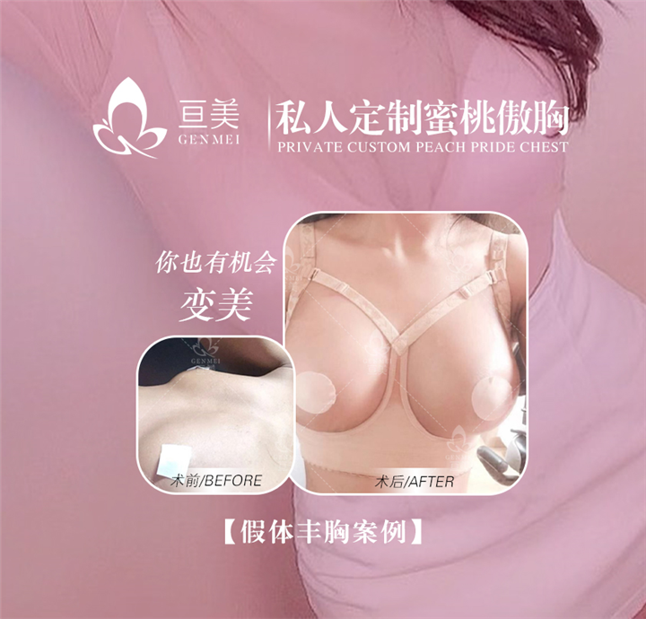 南昌亘美医疗假体丰胸