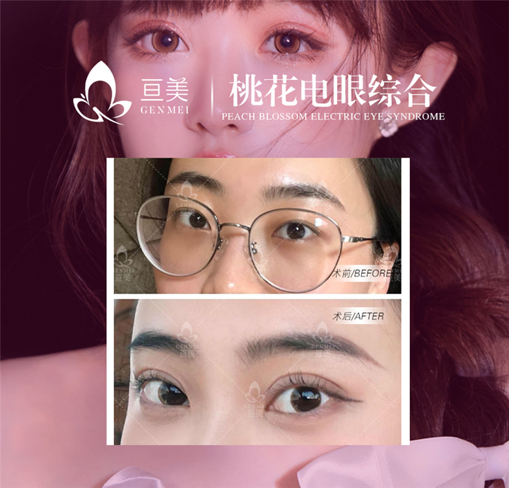 南昌眼综合整形哪家好