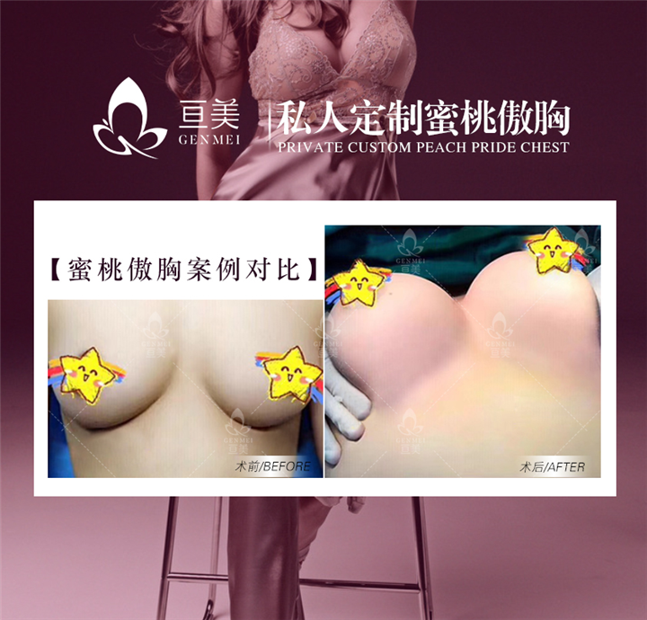 南昌隆胸整形