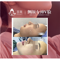 南昌下巴整形多少钱