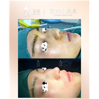 南昌肋骨鼻整形