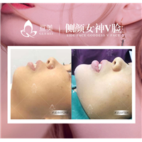 南昌亘美医疗下巴整形