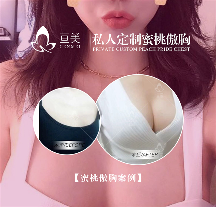 南昌隆胸整形医院