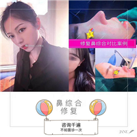 陈巧医生假体隆鼻整形案例 