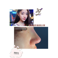 陈巧医生鼻综合整形 