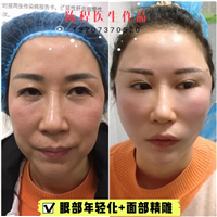 益阳线雕隆鼻 