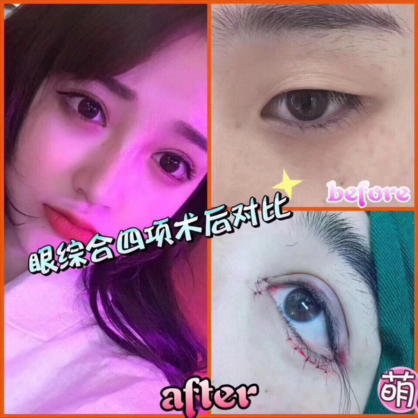 益阳做双眼皮整形多少钱 
