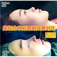 湖南做鼻综合整形哪家好 