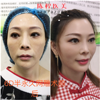 益阳面部线雕美容 
