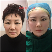 益阳面部线雕美容 