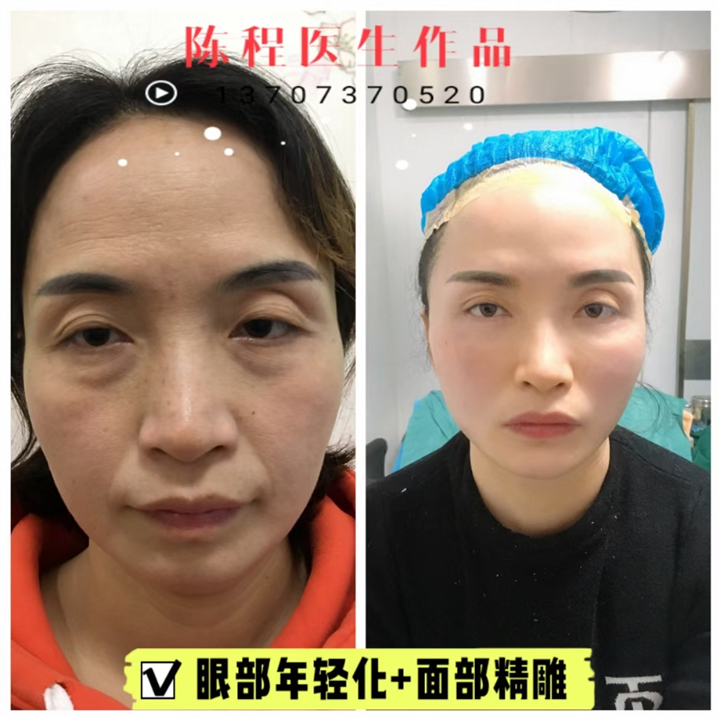 益阳线雕整形 