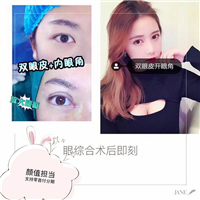 益阳双眼皮开眼角整形 