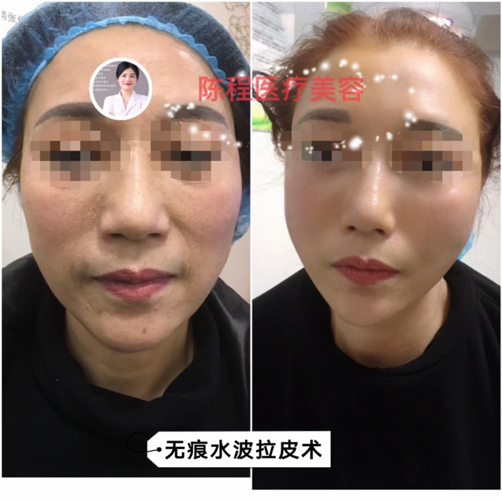 益阳面部线雕美容 