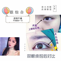 湖南做双眼皮的医生哪个好 