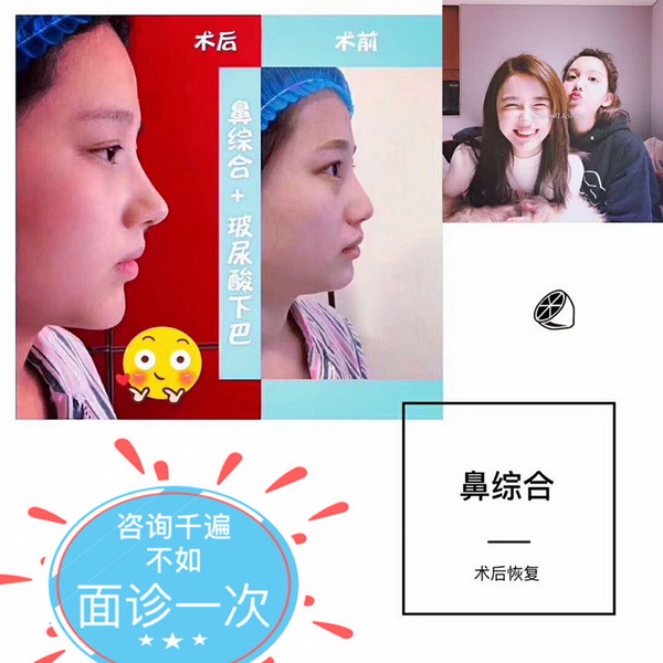 益阳假体隆鼻 