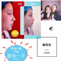 益阳假体隆鼻 