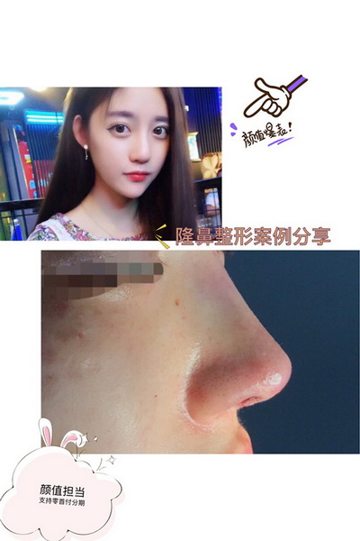 陈巧医生鼻综合整形 