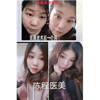益阳双眼皮整形 