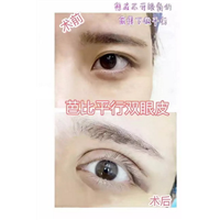益阳眼综合整形多少钱 