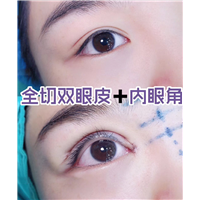 益阳双眼皮整形 