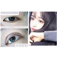 益阳开眼角整形 