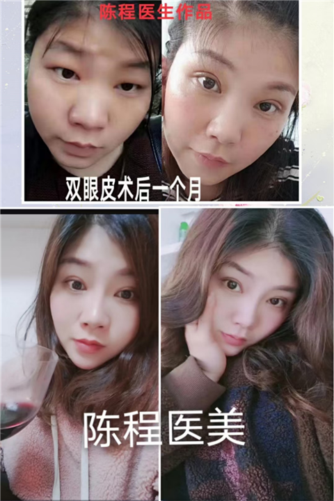 益阳双眼皮整形 