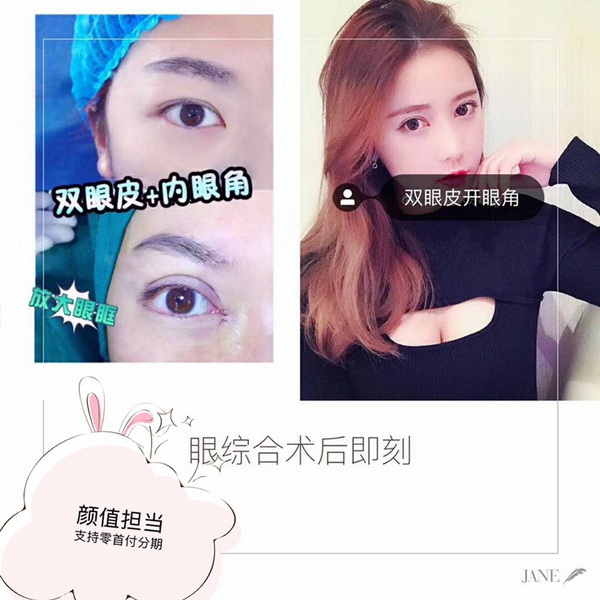 益阳双眼皮开眼角整形 