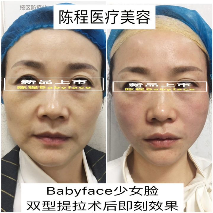 益阳面部线雕美容 