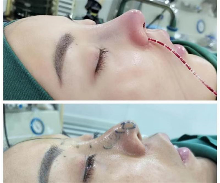 益阳假体隆鼻 