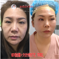 益阳面部线雕美容 