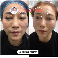 益阳面部线雕美容 