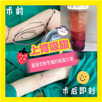 湖南益阳做吸脂整形哪里好 