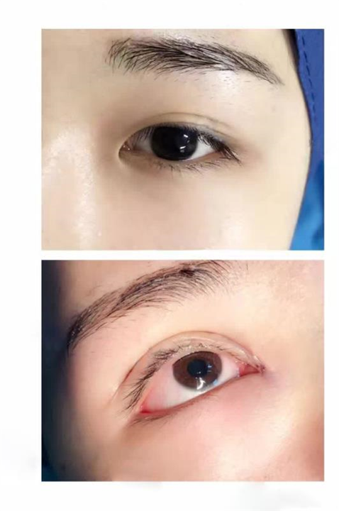 益阳双眼皮整形 