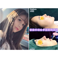 湖南假体隆鼻整形 