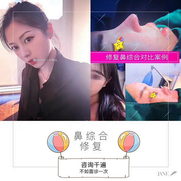 陈巧医生假体隆鼻整形案例 