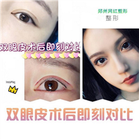 益阳双眼皮整形 
