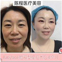 湖南线雕整形 