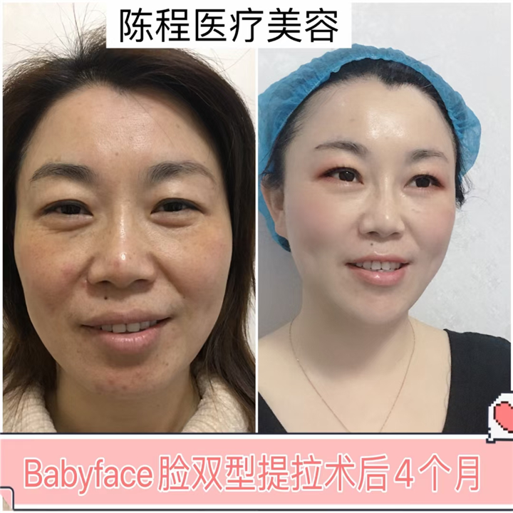 湖南线雕整形 
